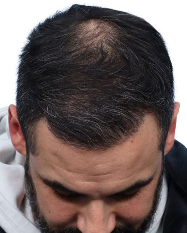 Fue Before and After | Dr. Jeffrey Wise