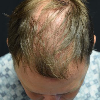 Fue Before and After | Dr. Jeffrey Wise