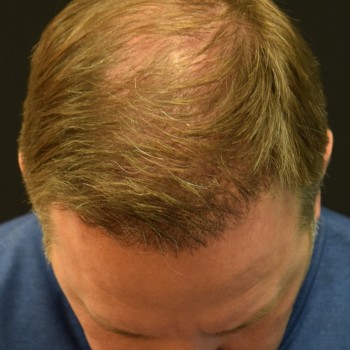 Fue Before and After | Dr. Jeffrey Wise