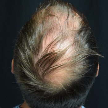 Fue Before and After | Dr. Jeffrey Wise