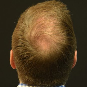 Fue Before and After | Dr. Jeffrey Wise