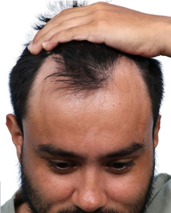 Fue Before and After | Dr. Jeffrey Wise