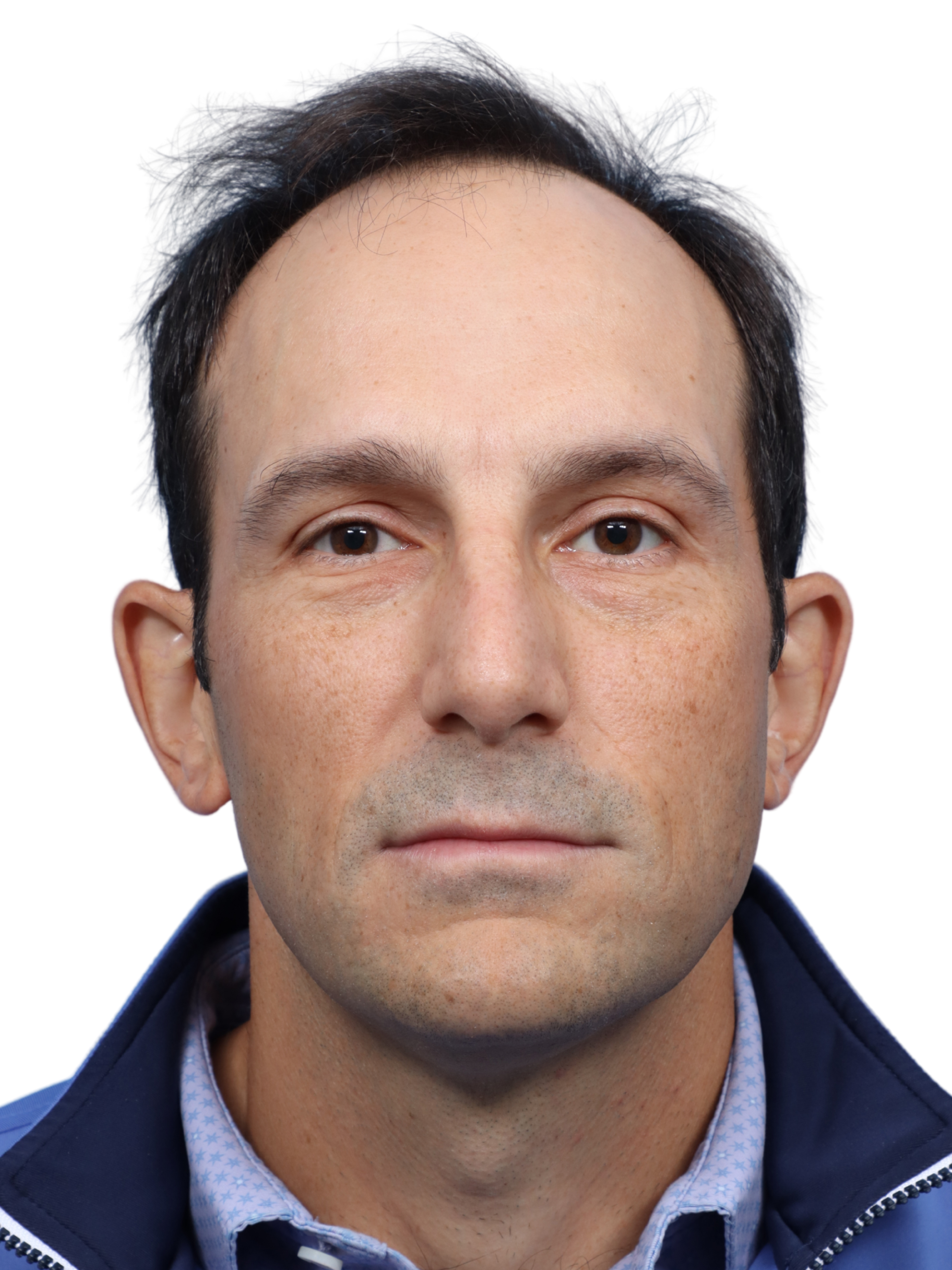 Fue Before and After | Dr. Jeffrey Wise