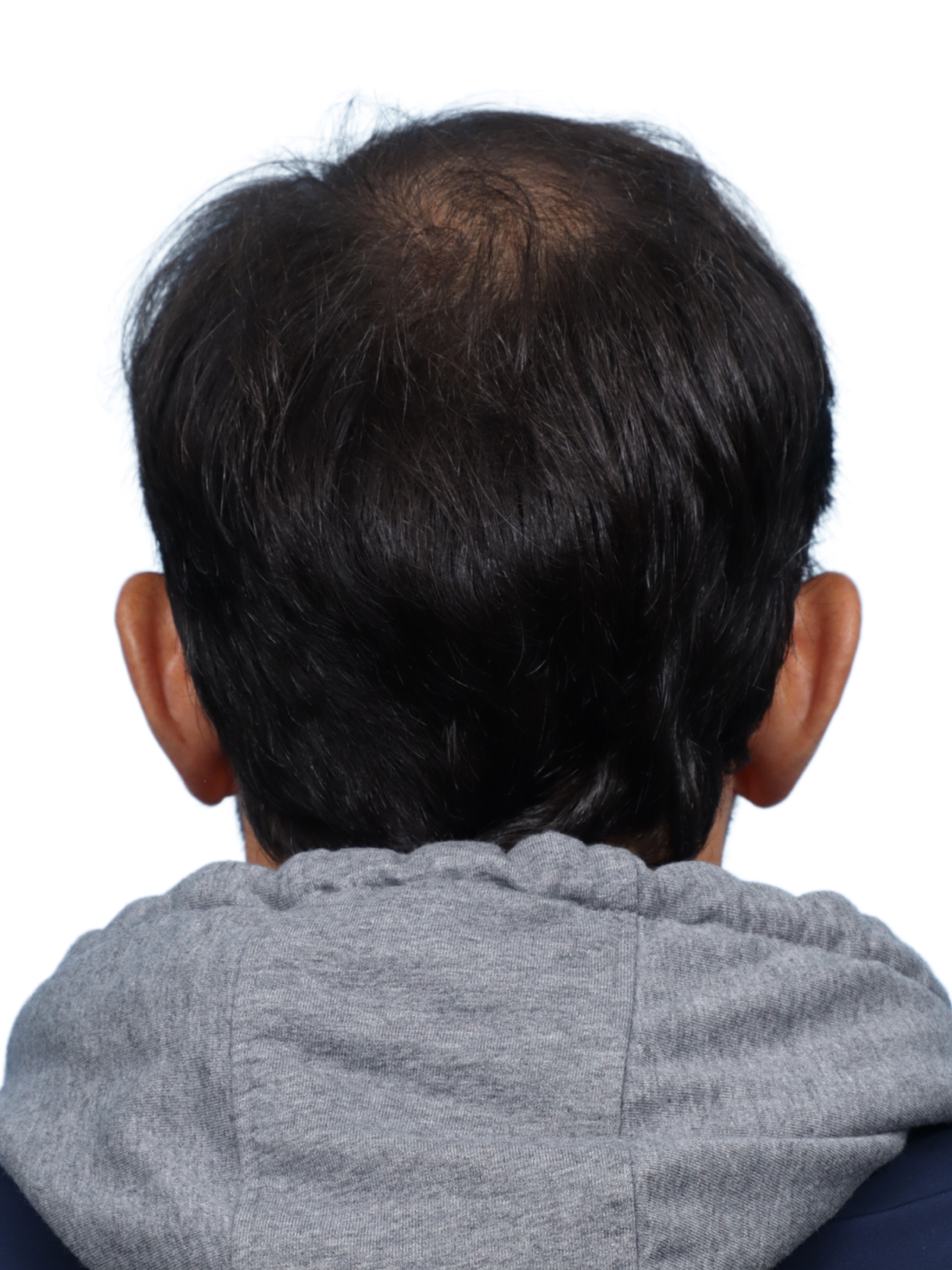 Fue Before and After | Dr. Jeffrey Wise