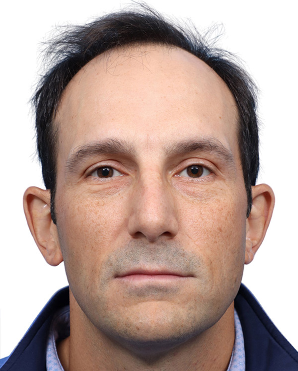 Fue Before and After | Dr. Jeffrey Wise