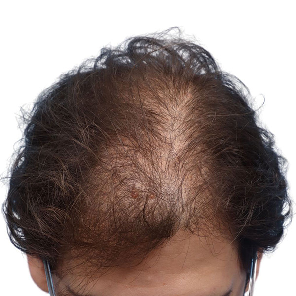 Fue Before and After | Dr. Jeffrey Wise