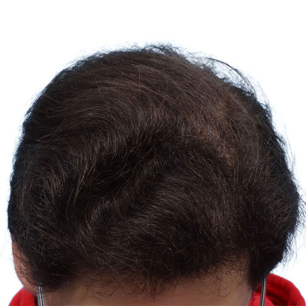 Fue Before and After | Dr. Jeffrey Wise