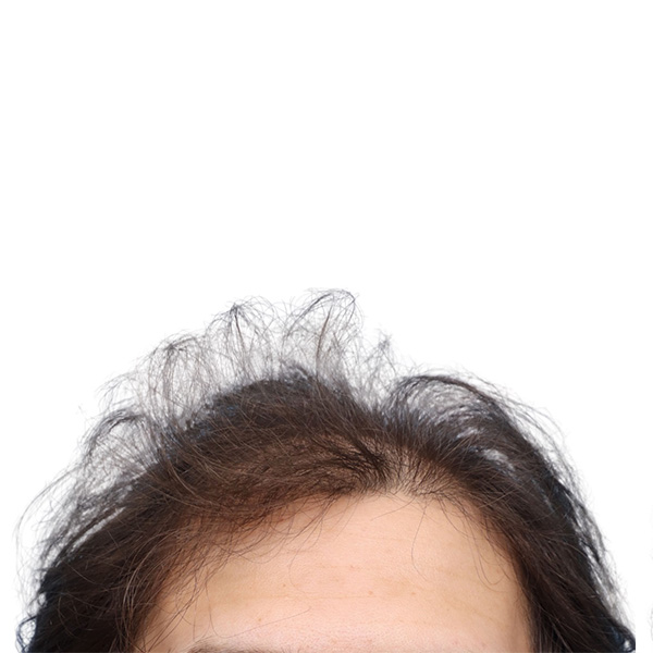 Fue Before and After | Dr. Jeffrey Wise
