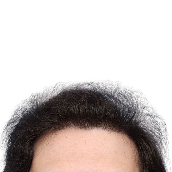 Fue Before and After | Dr. Jeffrey Wise