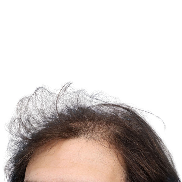 Fue Before and After | Dr. Jeffrey Wise
