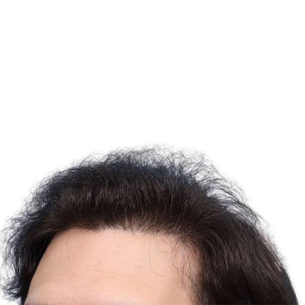 Fue Before and After | Dr. Jeffrey Wise