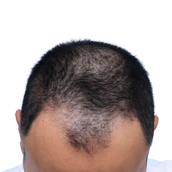 Fue Before and After | Dr. Jeffrey Wise