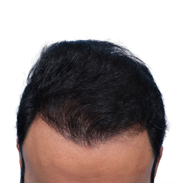 Fue Before and After | Dr. Jeffrey Wise