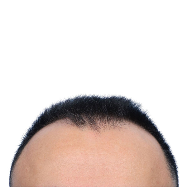 Fue Before and After | Dr. Jeffrey Wise