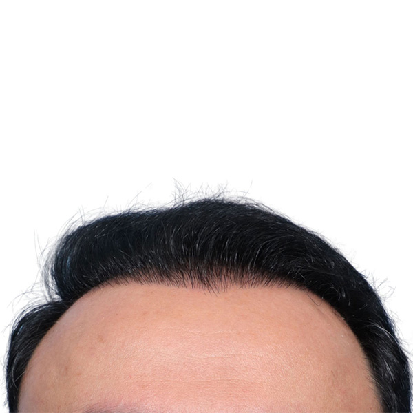 Fue Before and After | Dr. Jeffrey Wise