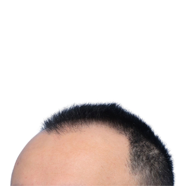 Fue Before and After | Dr. Jeffrey Wise