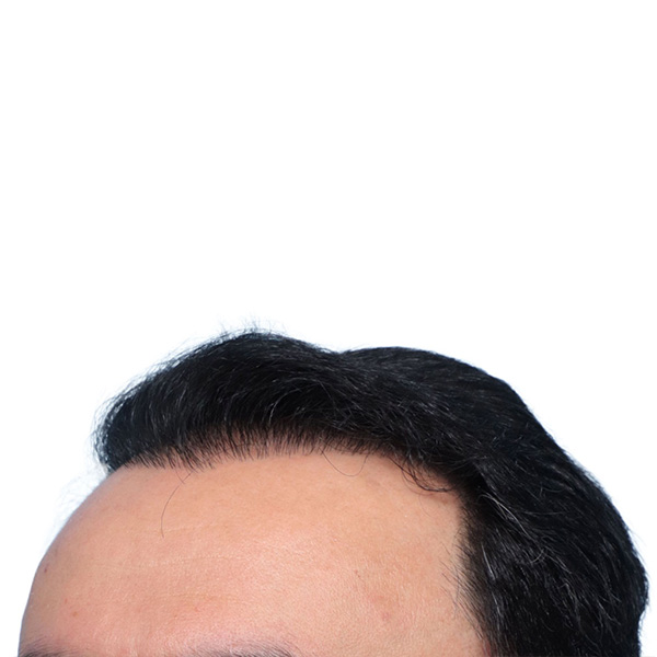 Fue Before and After | Dr. Jeffrey Wise
