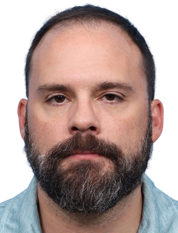 Fue Before and After | Dr. Jeffrey Wise