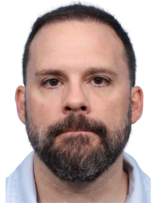 Fue Before and After | Dr. Jeffrey Wise