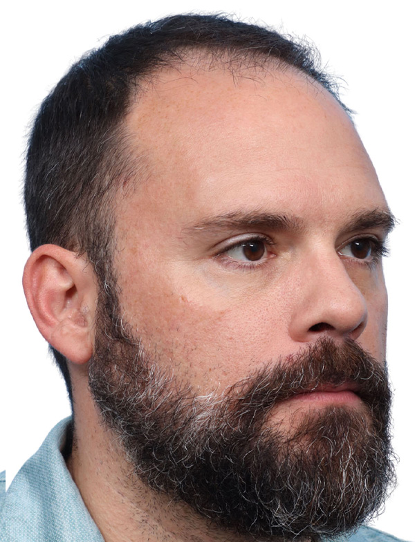 Fue Before and After | Dr. Jeffrey Wise