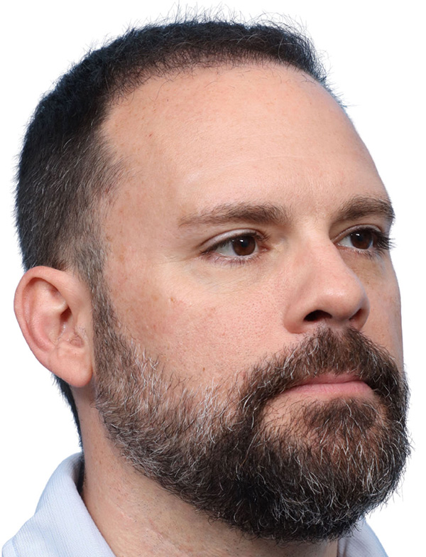 Fue Before and After | Dr. Jeffrey Wise
