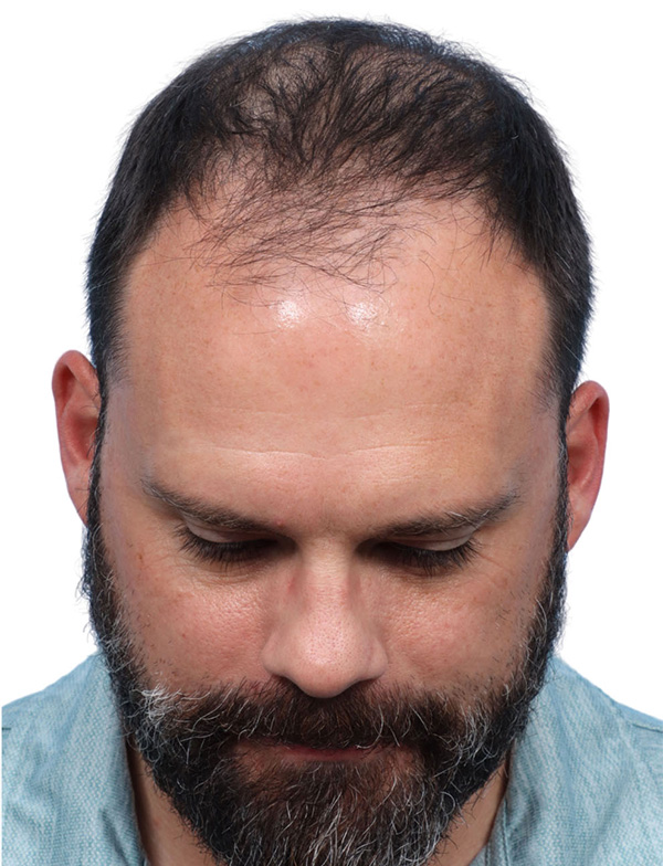 Fue Before and After | Dr. Jeffrey Wise