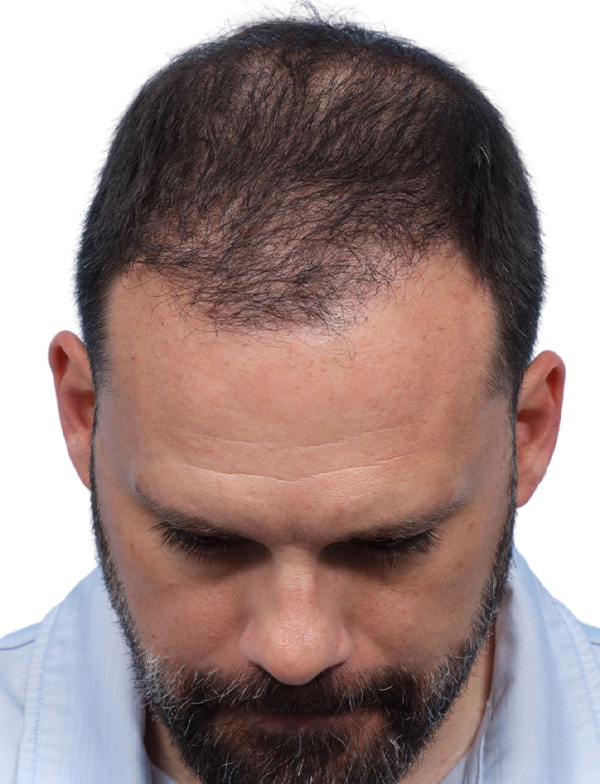 Fue Before and After | Dr. Jeffrey Wise