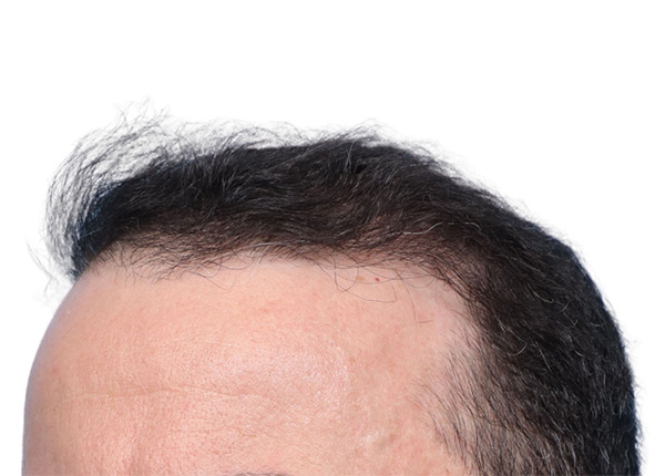 Fue Before and After | Dr. Jeffrey Wise