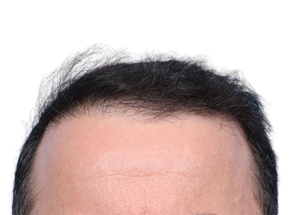 Fue Before and After | Dr. Jeffrey Wise