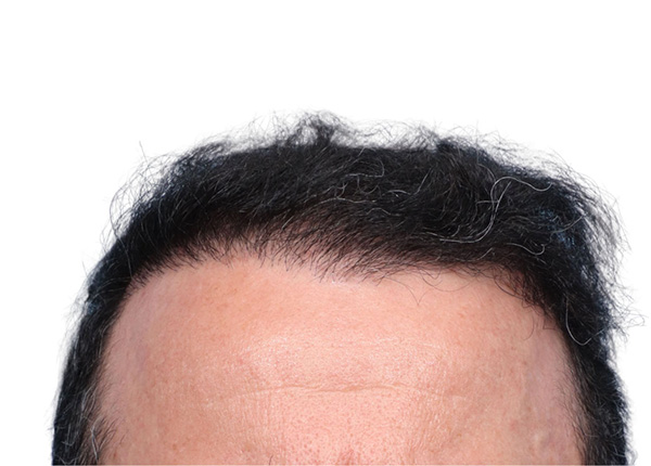 Fue Before and After | Dr. Jeffrey Wise