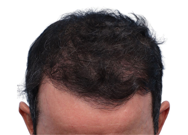 Fue Before and After | Dr. Jeffrey Wise