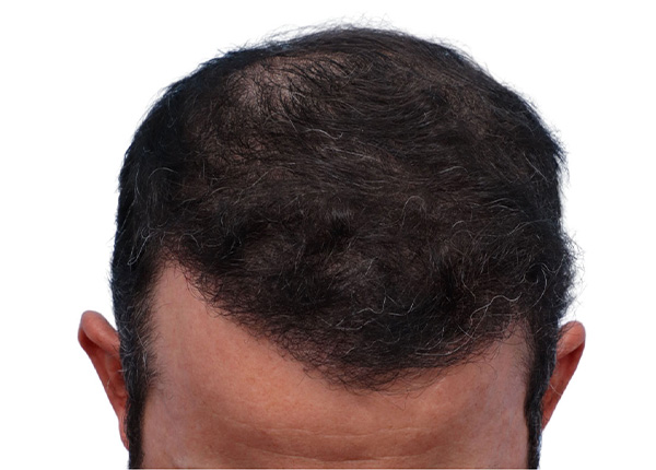 Fue Before and After | Dr. Jeffrey Wise