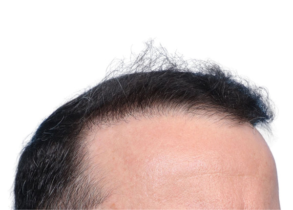 Fue Before and After | Dr. Jeffrey Wise