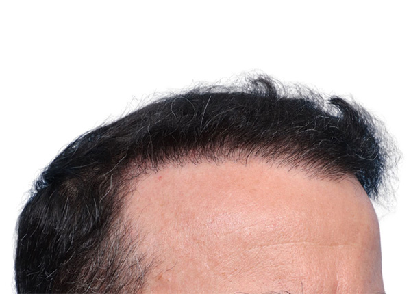 Fue Before and After | Dr. Jeffrey Wise