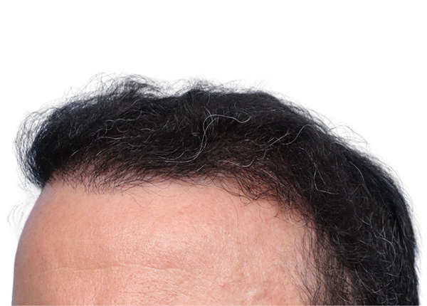 Fue Before and After | Dr. Jeffrey Wise