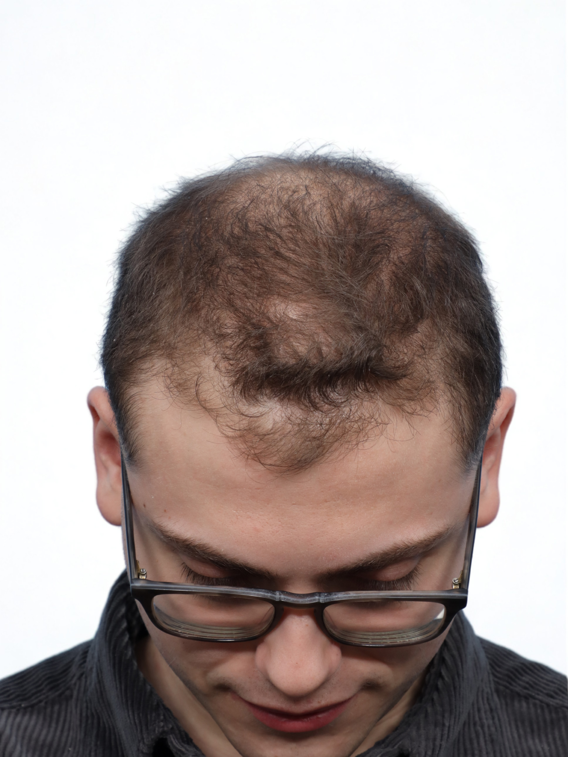 Fue Before and After | Dr. Jeffrey Wise
