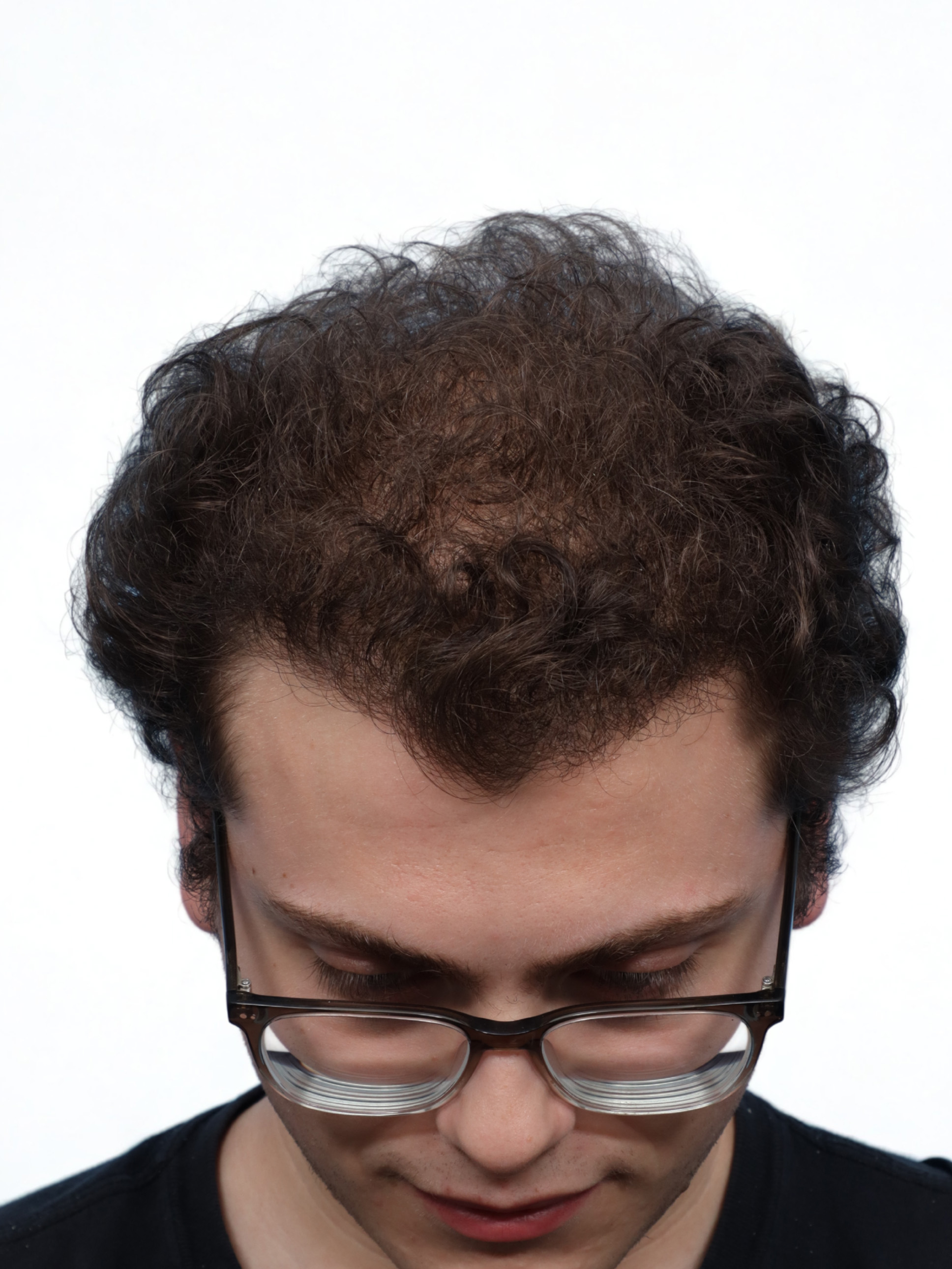 Fue Before and After | Dr. Jeffrey Wise