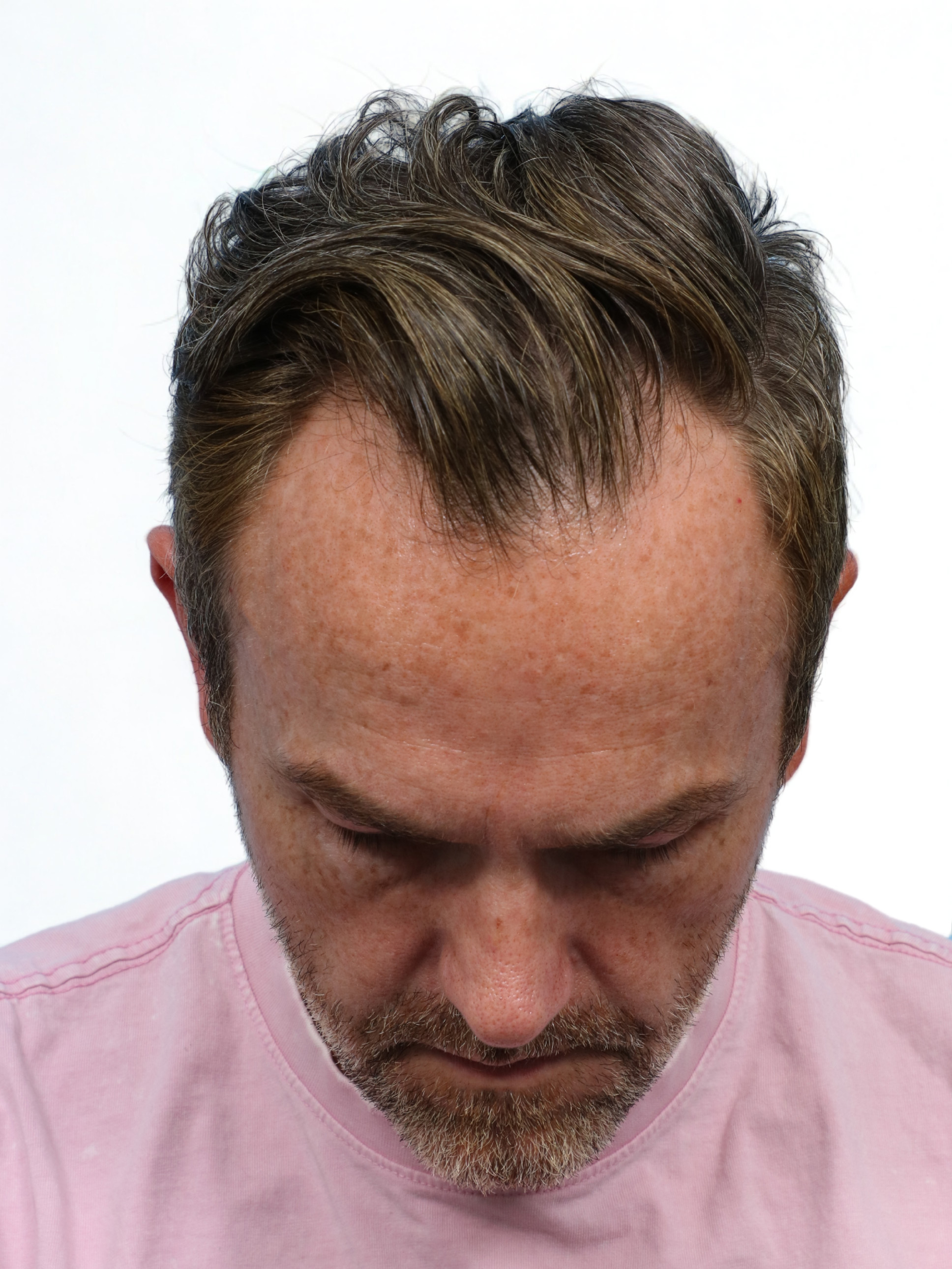 Fue Before and After | Dr. Jeffrey Wise
