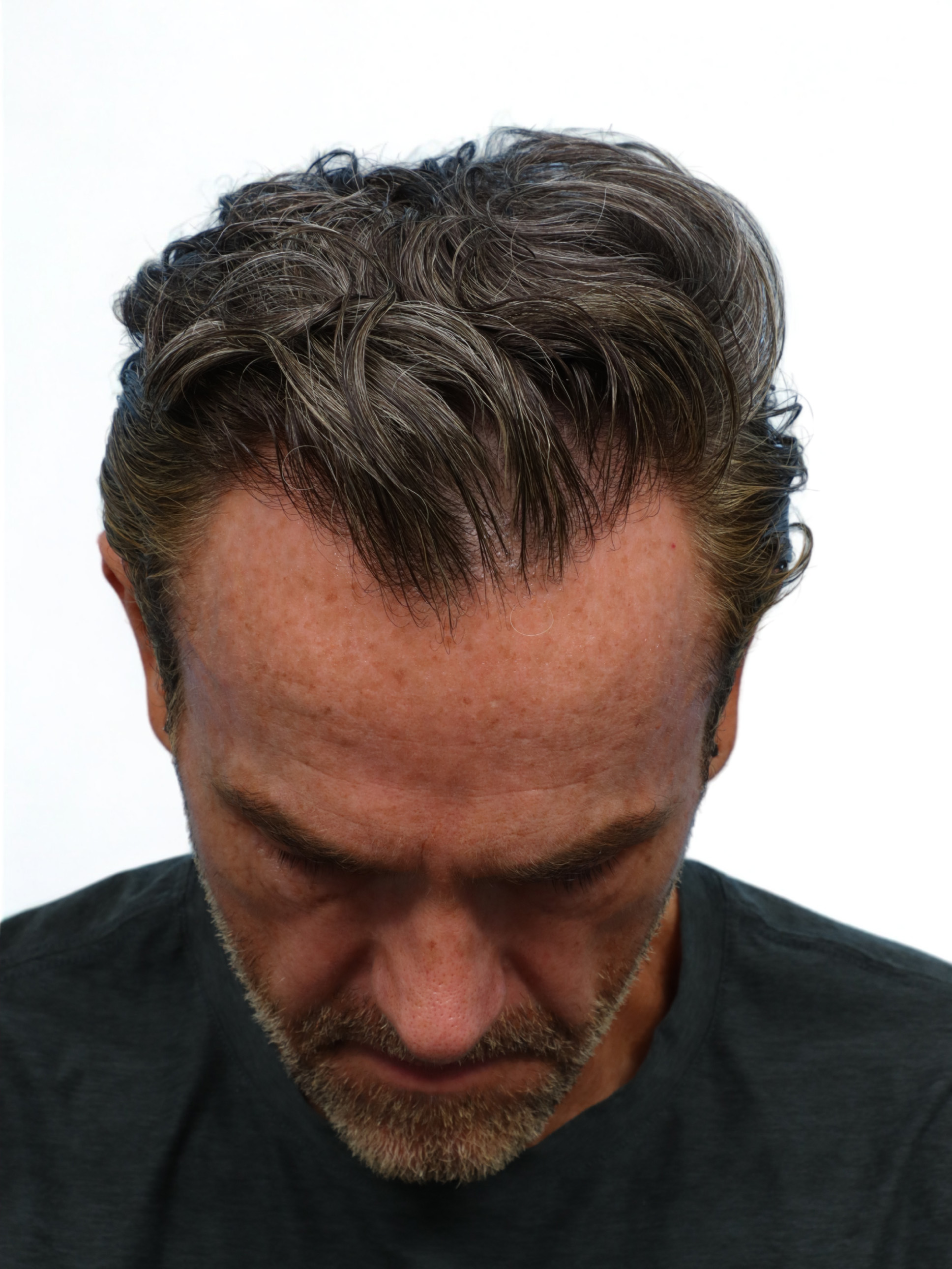 Fue Before and After | Dr. Jeffrey Wise