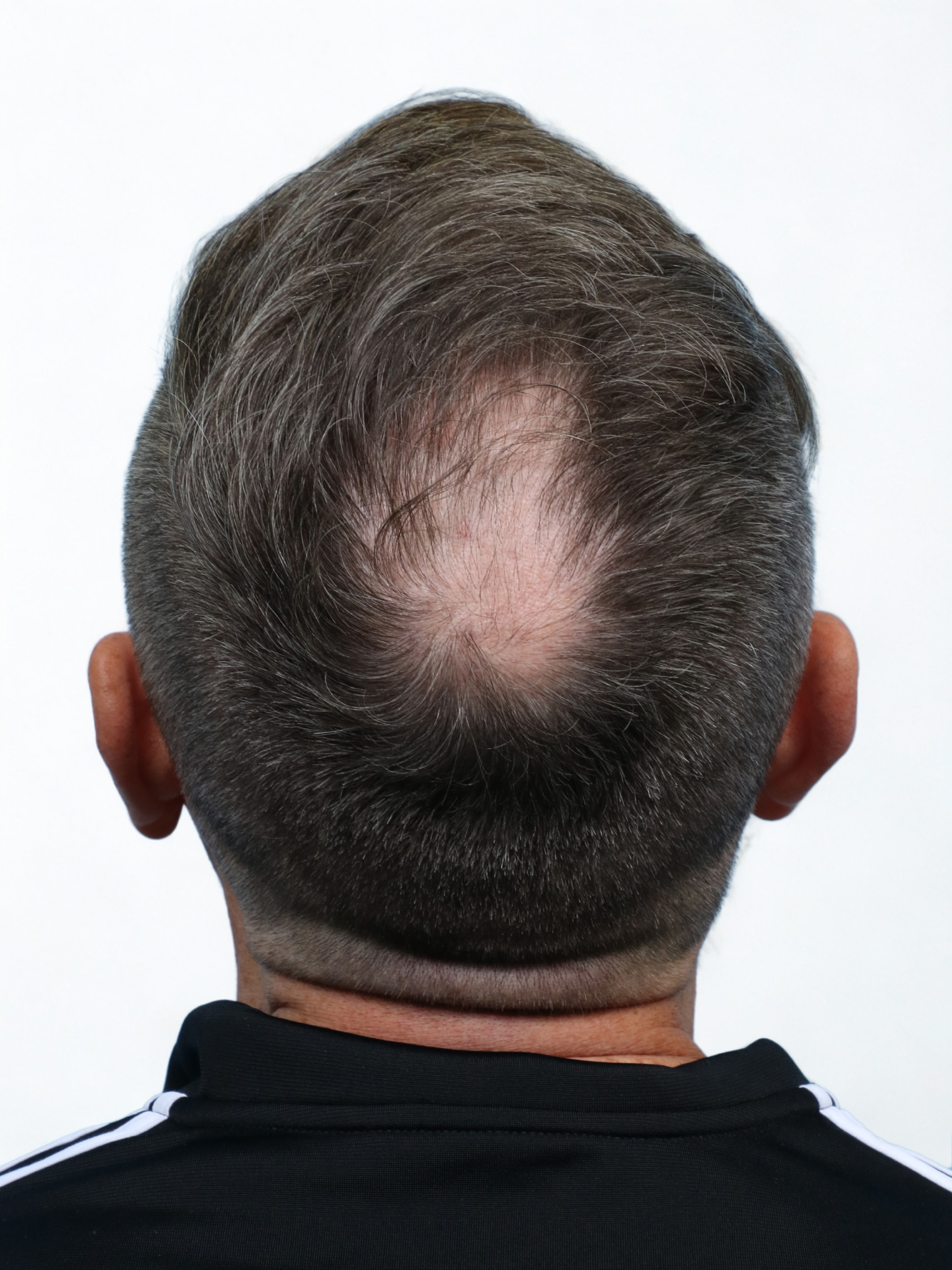 Fue Before and After | Dr. Jeffrey Wise