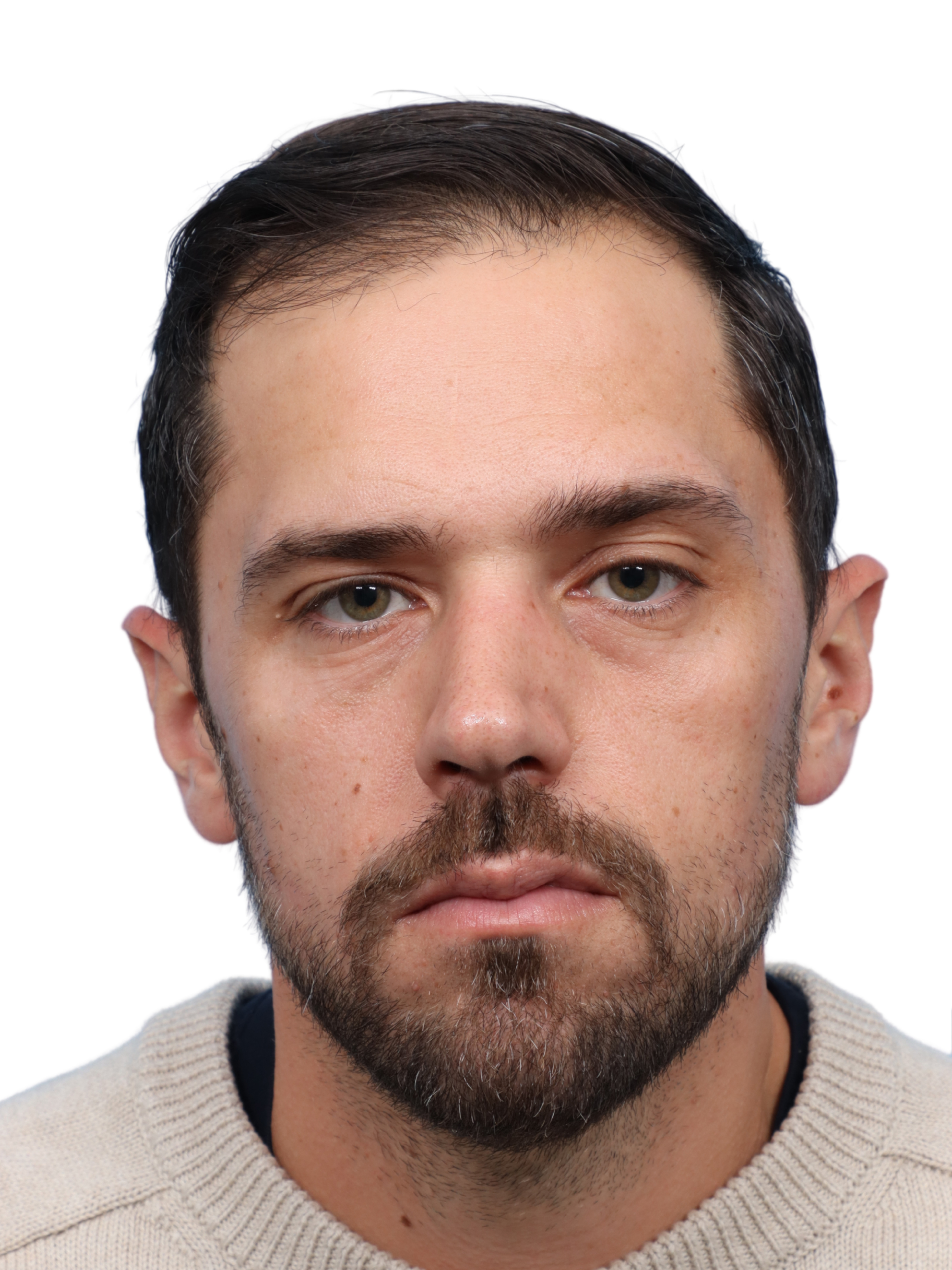 Fue Before and After | Dr. Jeffrey Wise