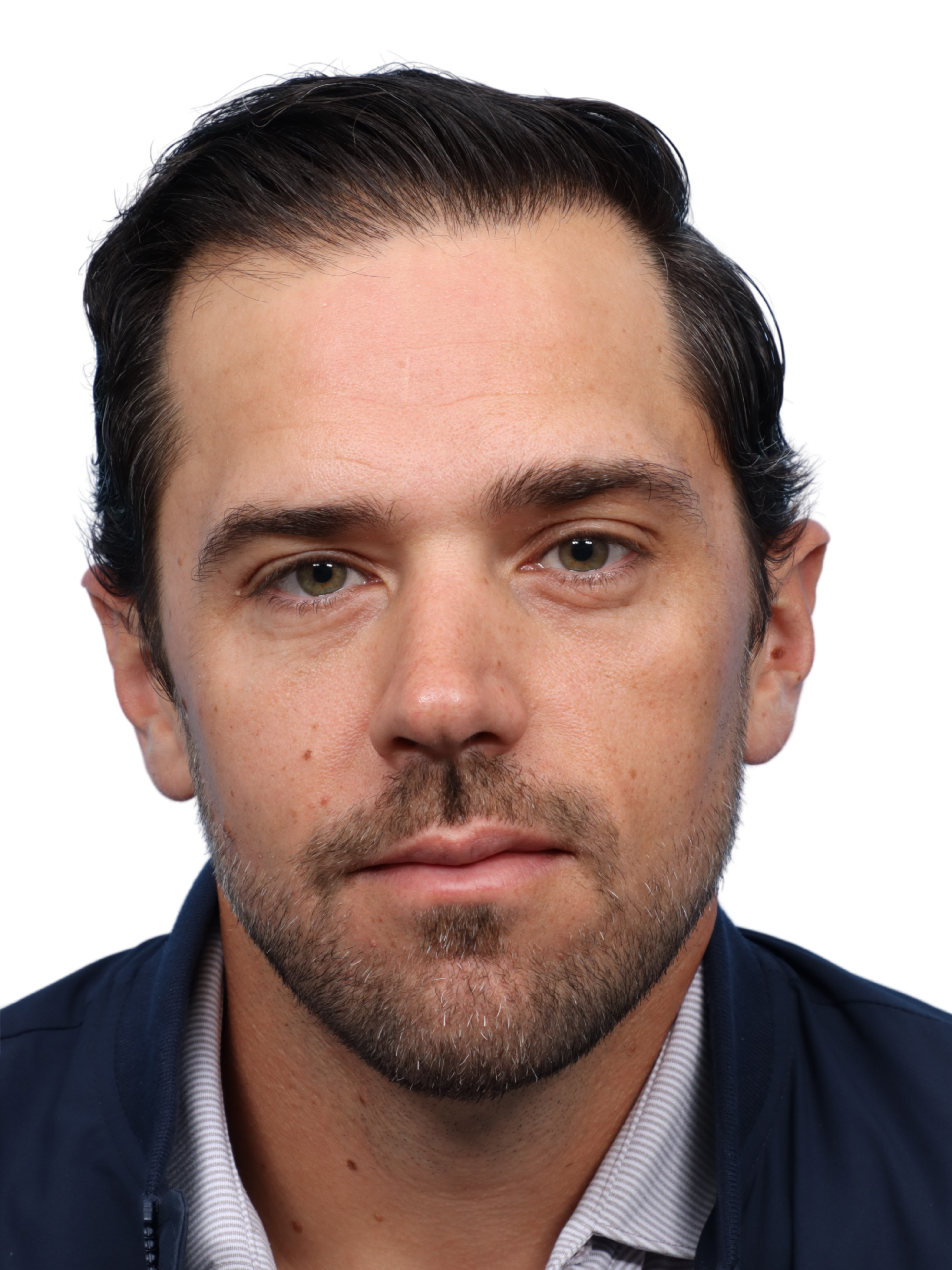 Fue Before and After | Dr. Jeffrey Wise