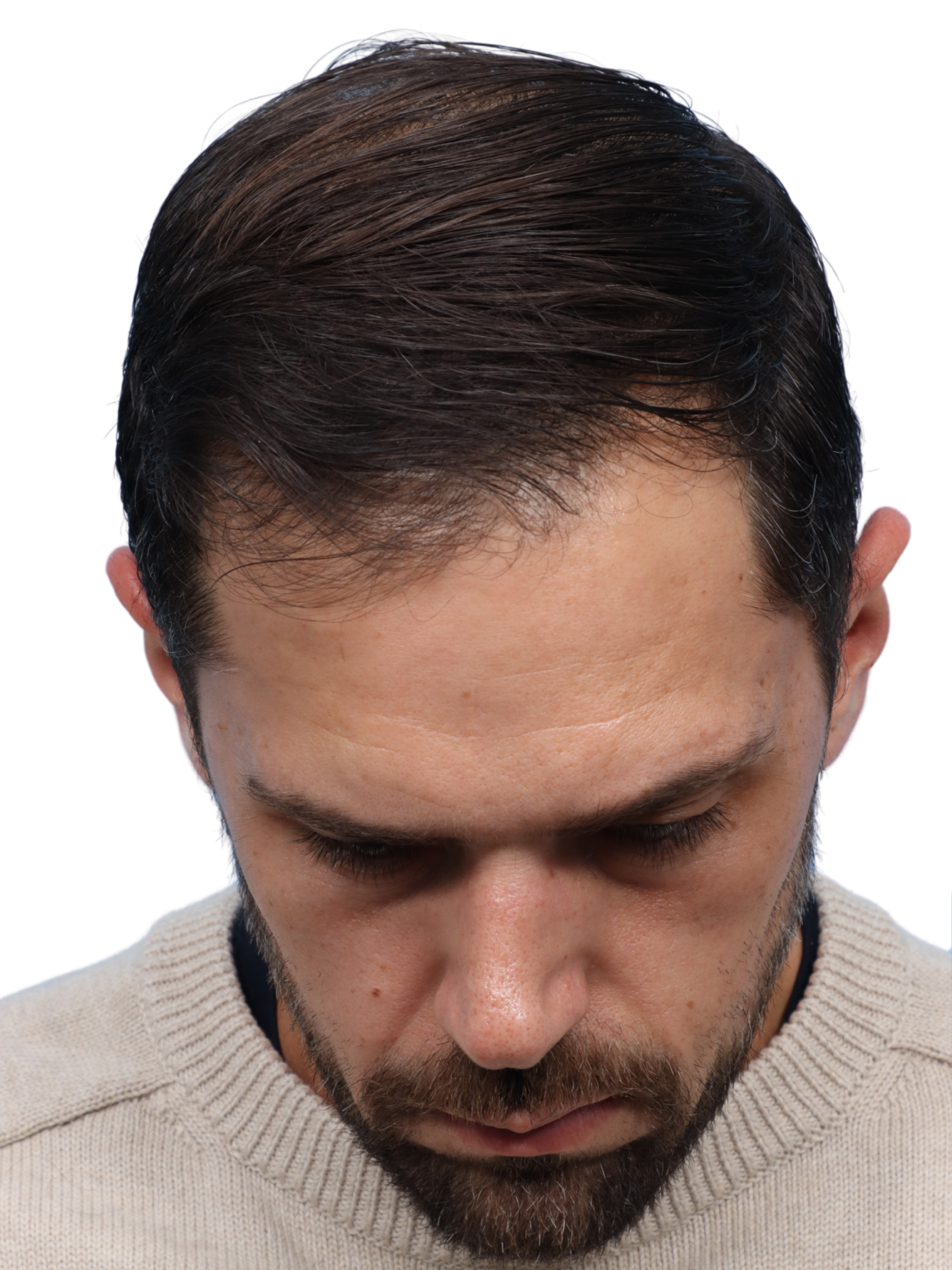 Fue Before and After | Dr. Jeffrey Wise