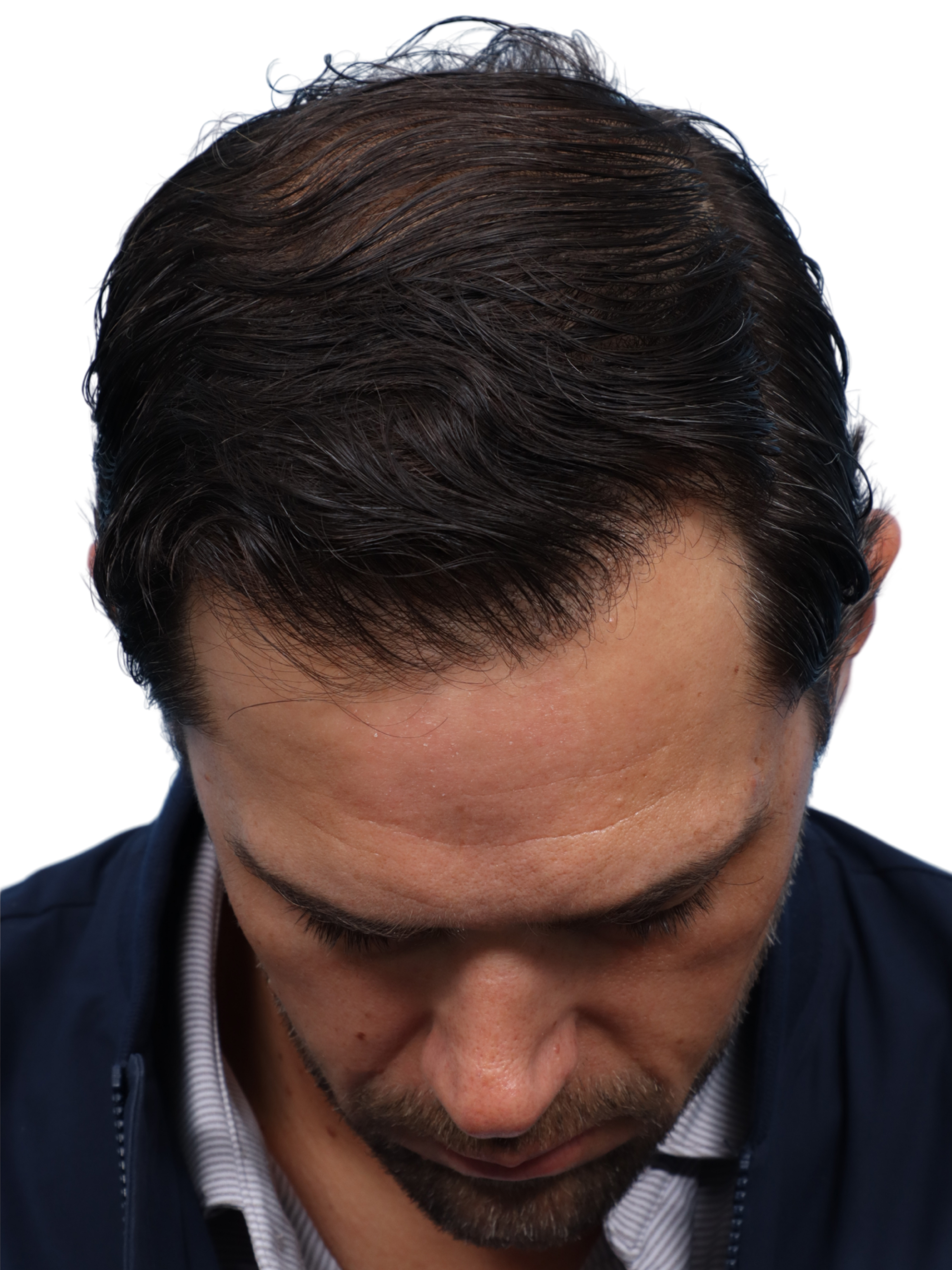 Fue Before and After | Dr. Jeffrey Wise