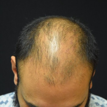 Fue Before and After | Dr. Jeffrey Wise