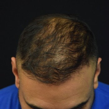 Fue Before and After | Dr. Jeffrey Wise