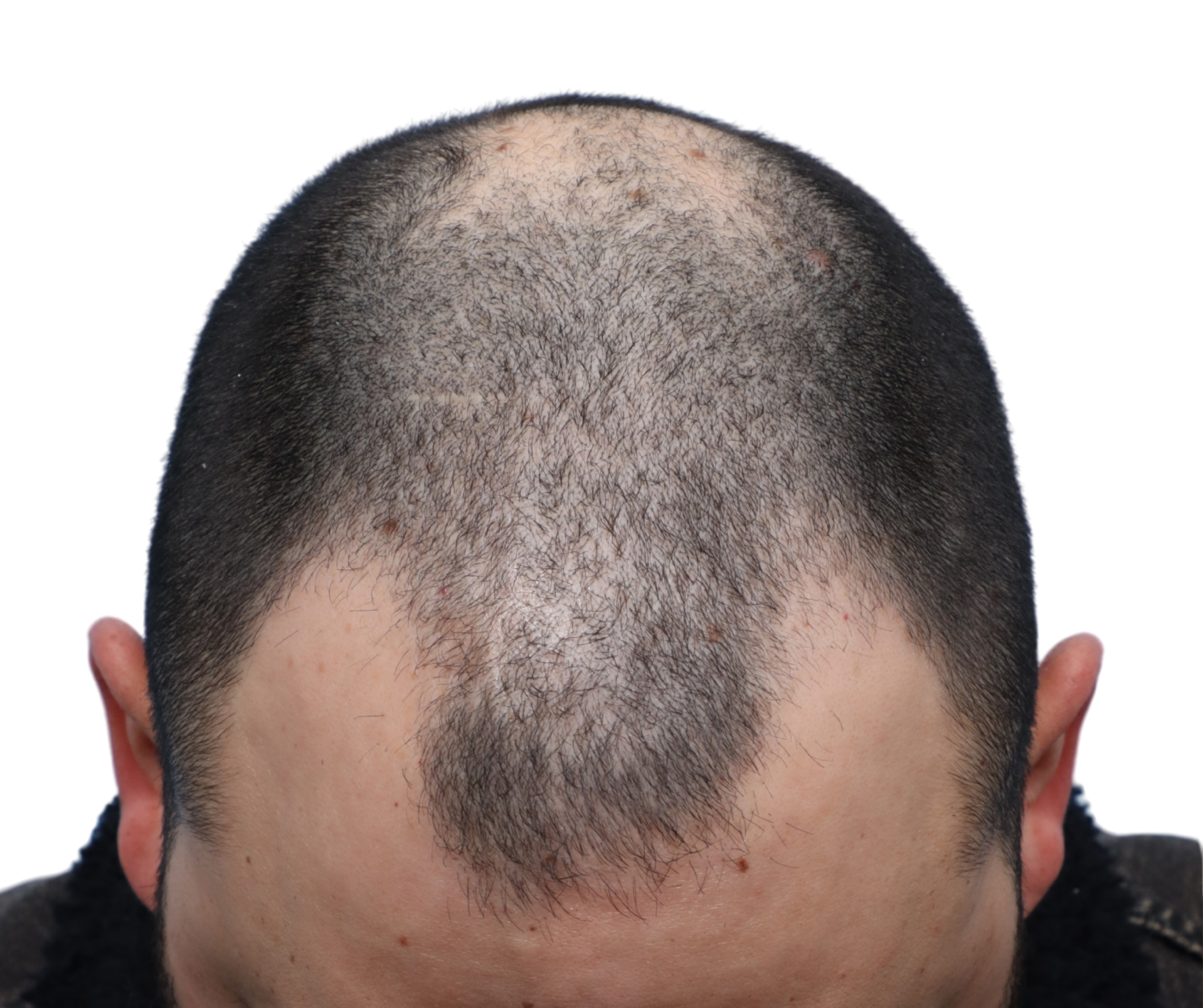Fue Before and After | Dr. Jeffrey Wise