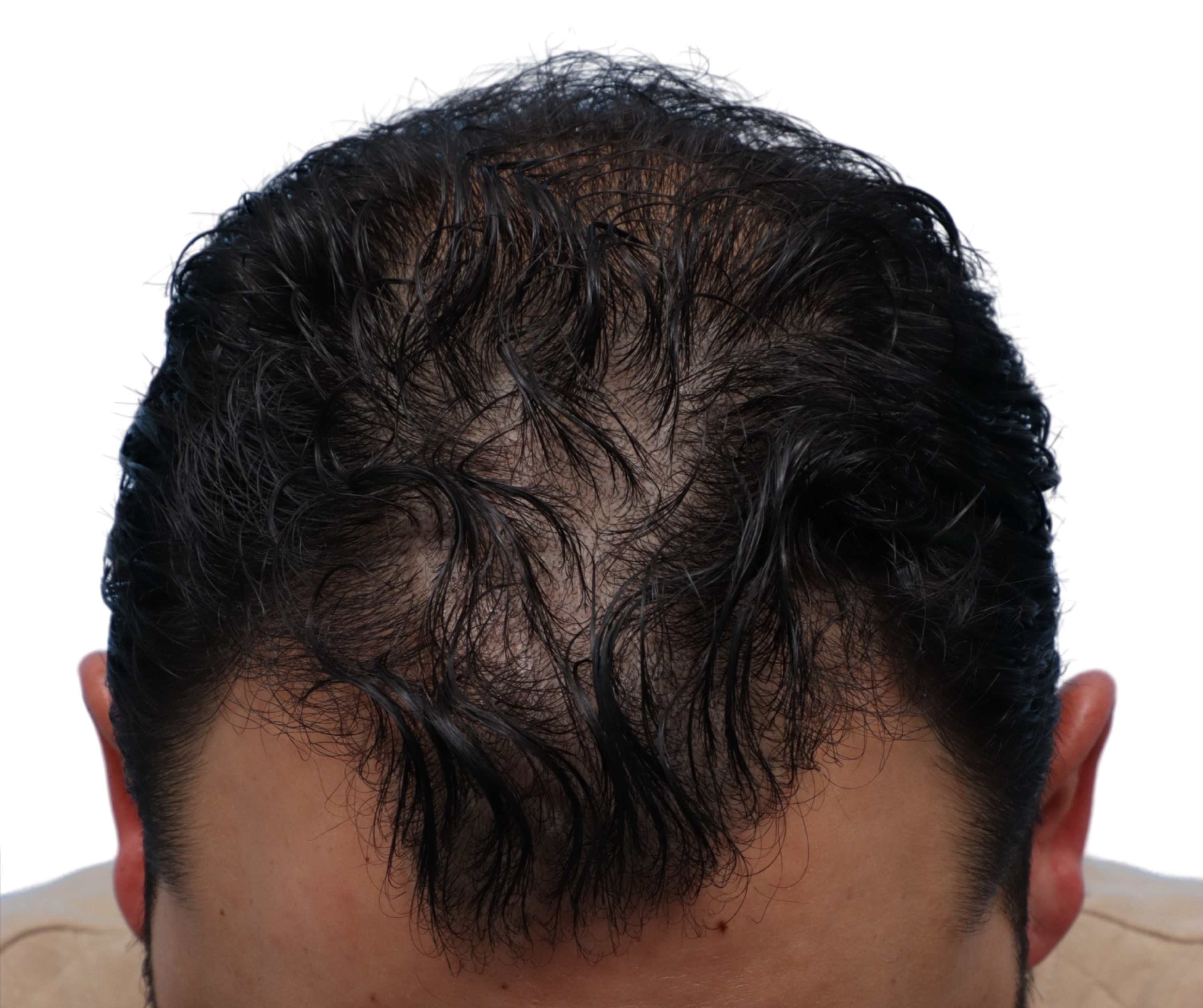Fue Before and After | Dr. Jeffrey Wise