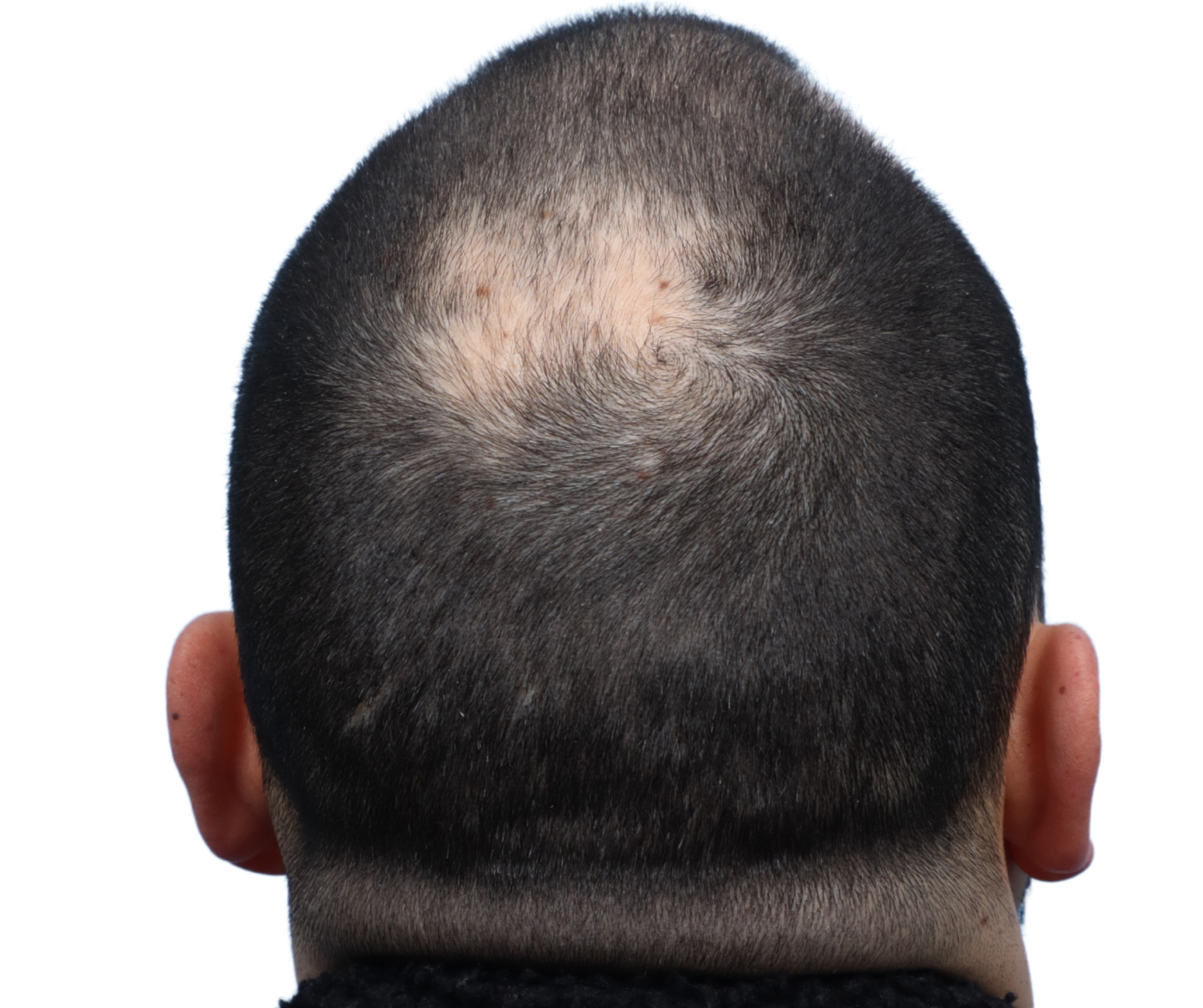 Fue Before and After | Dr. Jeffrey Wise