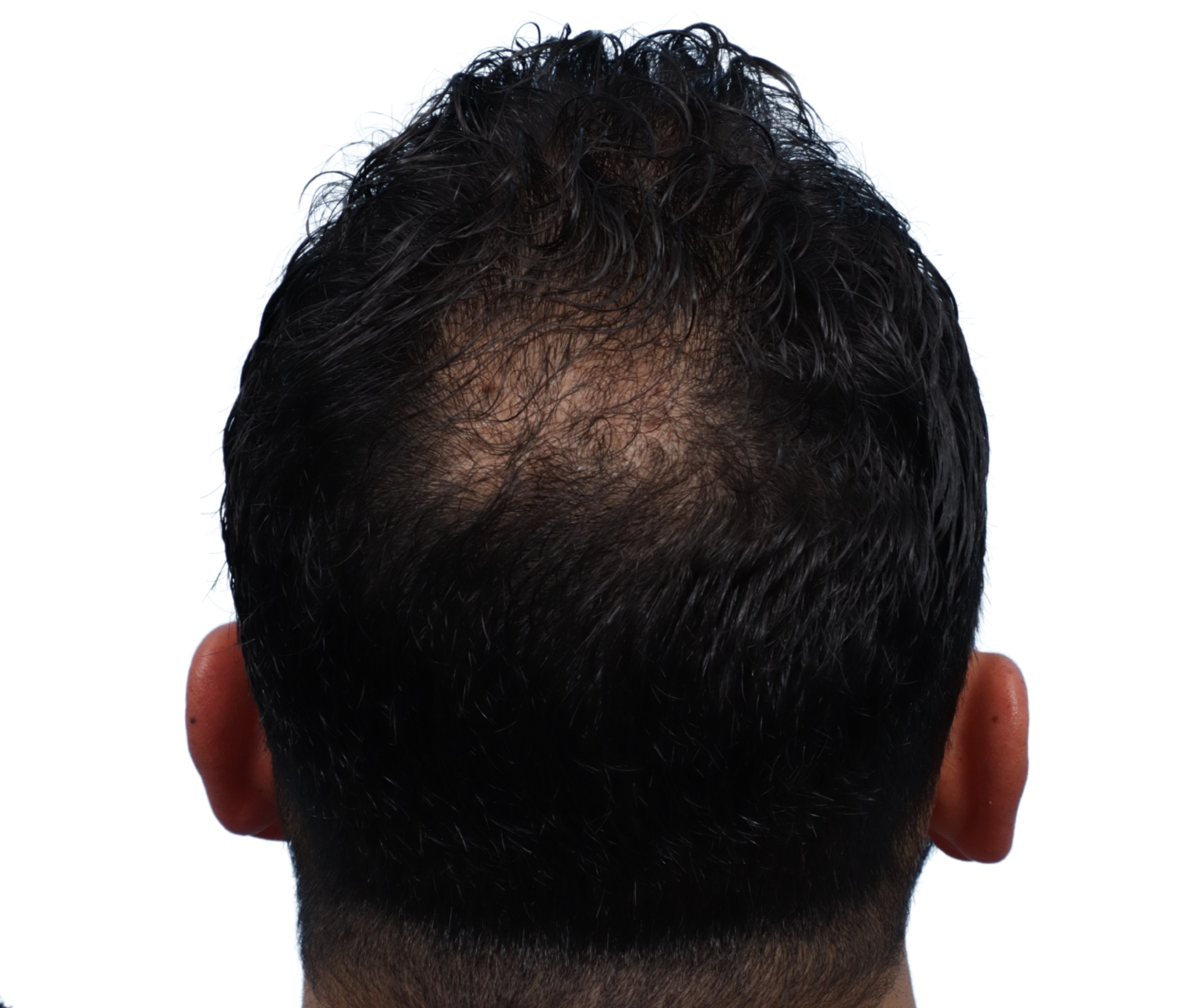 Fue Before and After | Dr. Jeffrey Wise
